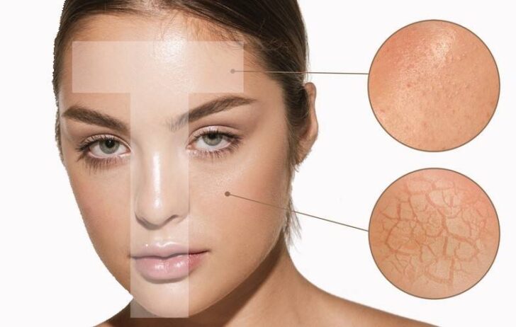 Oily and Combination Skin